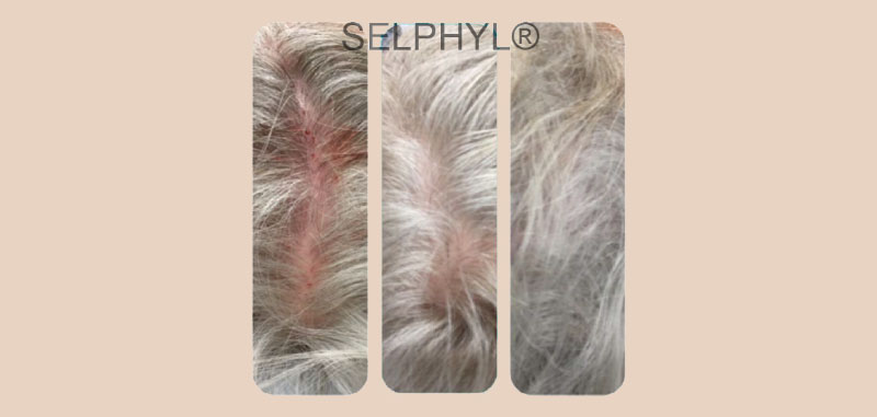 PRFM Hair Loss Before And After Gallery garden city ny